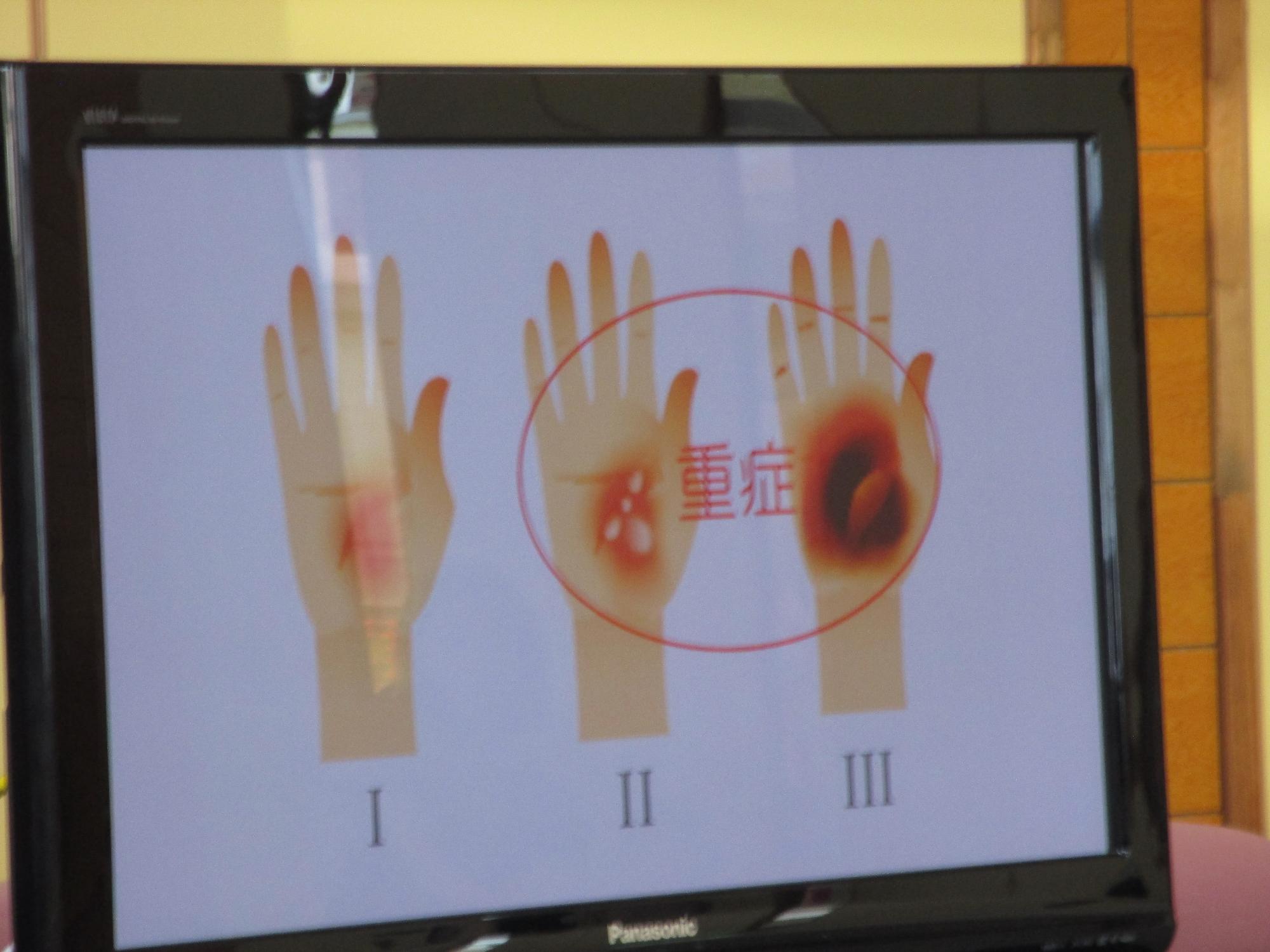 テレビ画面に映った掌のやけど、1から3まで数字が上がるほど症状は重い。